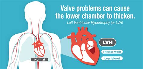 lvh medical abbreviation|is lvh life threatening.